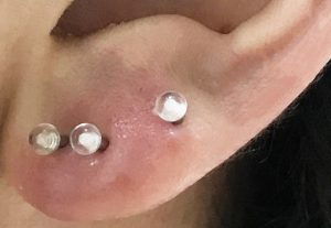 ピアスによる耳たぶの腫れや痛み、膿などのトラブル