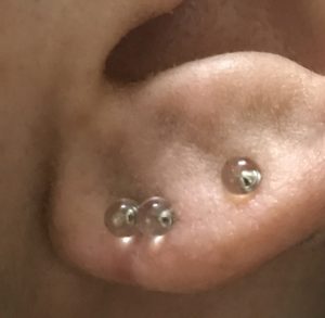 ピアスによる耳たぶの腫れや痛み、膿などのトラブルが治った