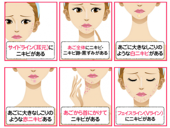 顎ニキビは、いわゆる「大人ニキビ」と呼ばれるニキビの一つ