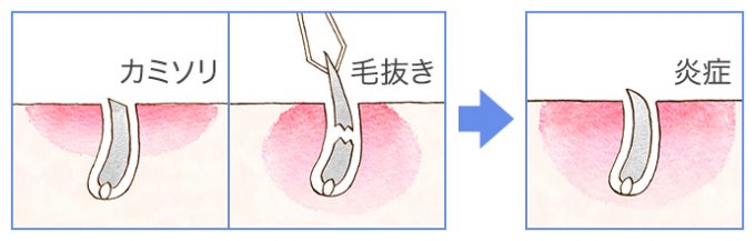 毛穴周りの表皮や角質層が削られたり、毛穴に細菌が入り、毛膿炎や毛包炎等の炎症が起きる